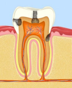 carious human tooth