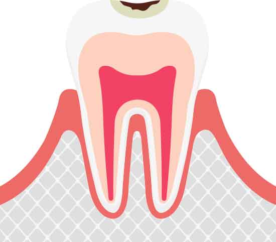 エナメル質の虫歯