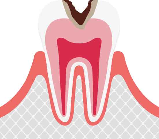 象牙質の虫歯