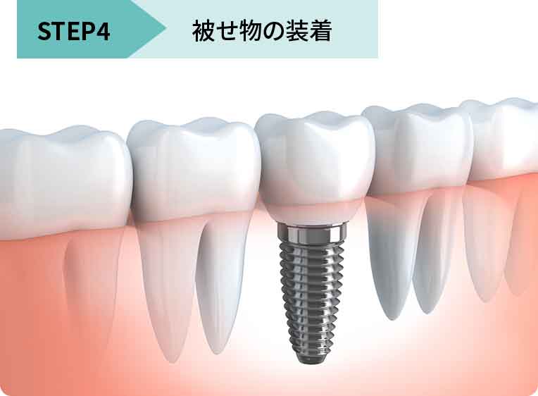 被せ物の装着〜被せ物の型取り