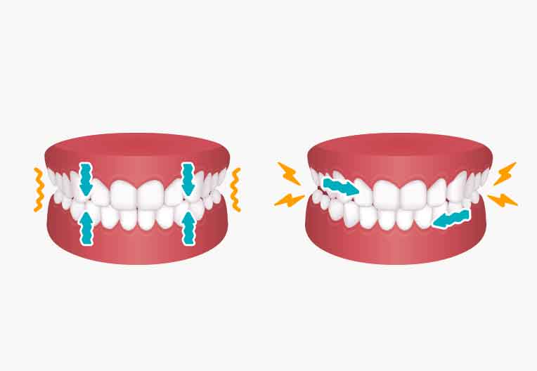 歯ぎしりによるダメージから歯を守りましょう