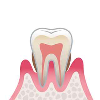 歯肉炎、軽度・中等度の歯周炎