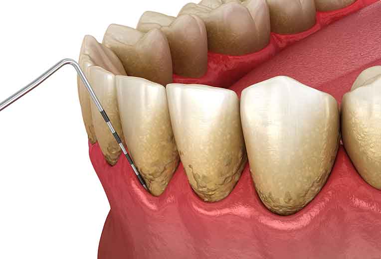 歯石とり（スケーリング、ルートプレーニング）