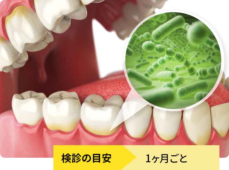 重度歯周病の進行抑制