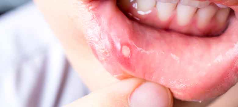 口内炎の原因には歯トラブルが関係している