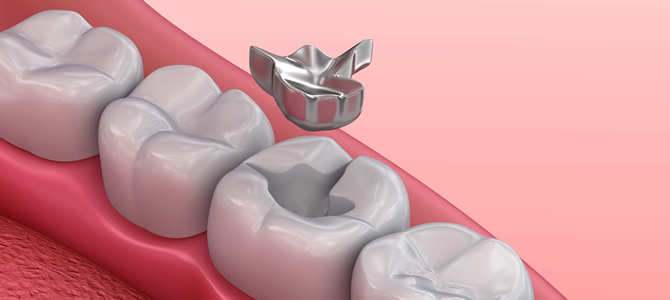 歯の詰め物が取れたときに取るべき行動は？